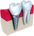 Denti3d1