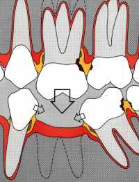 Limare i denti