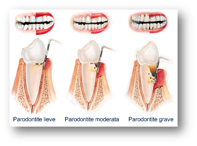 Stadi della paradontite