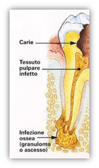 Granuloma dentale