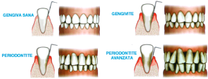 Infiammazione gengivale